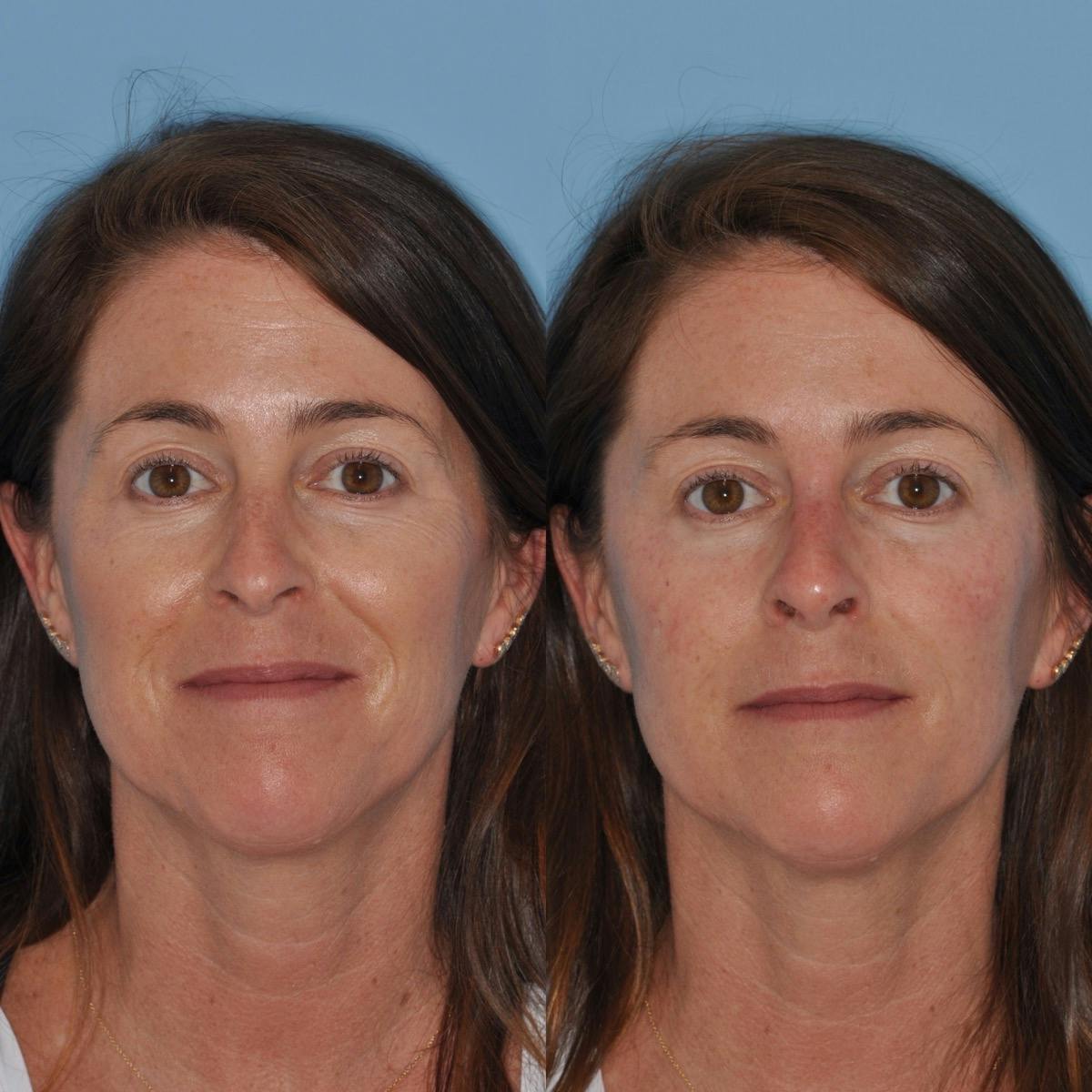 Non-Surgical Rhinoplasty Before & After Gallery - Patient 690284 - Image 8