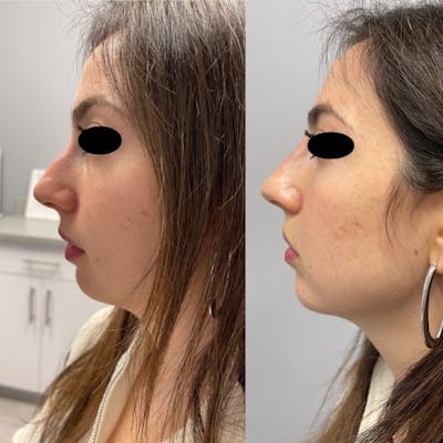 Non-Surgical Rhinoplasty Before & After Gallery - Patient 929208 - Image 1