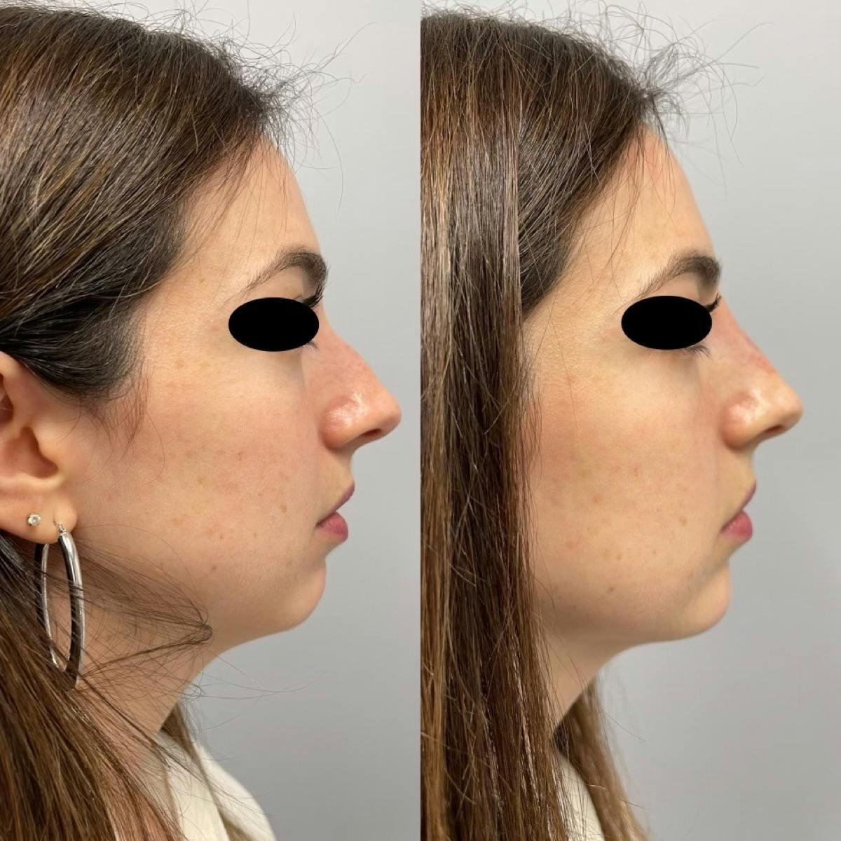 Non-Surgical Rhinoplasty Before & After Gallery - Patient 929208 - Image 2