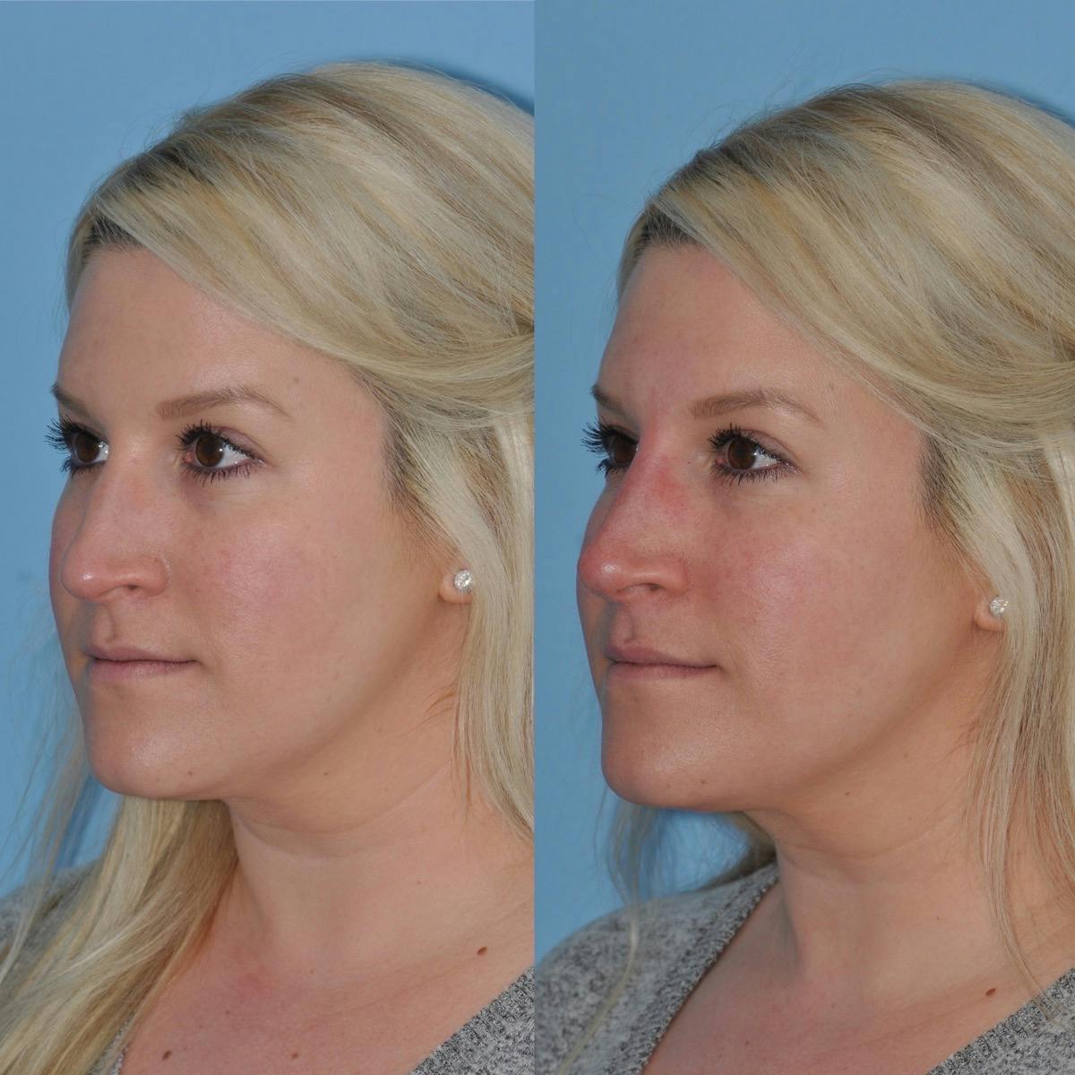 Non-Surgical Rhinoplasty Before & After Gallery - Patient 285241 - Image 2