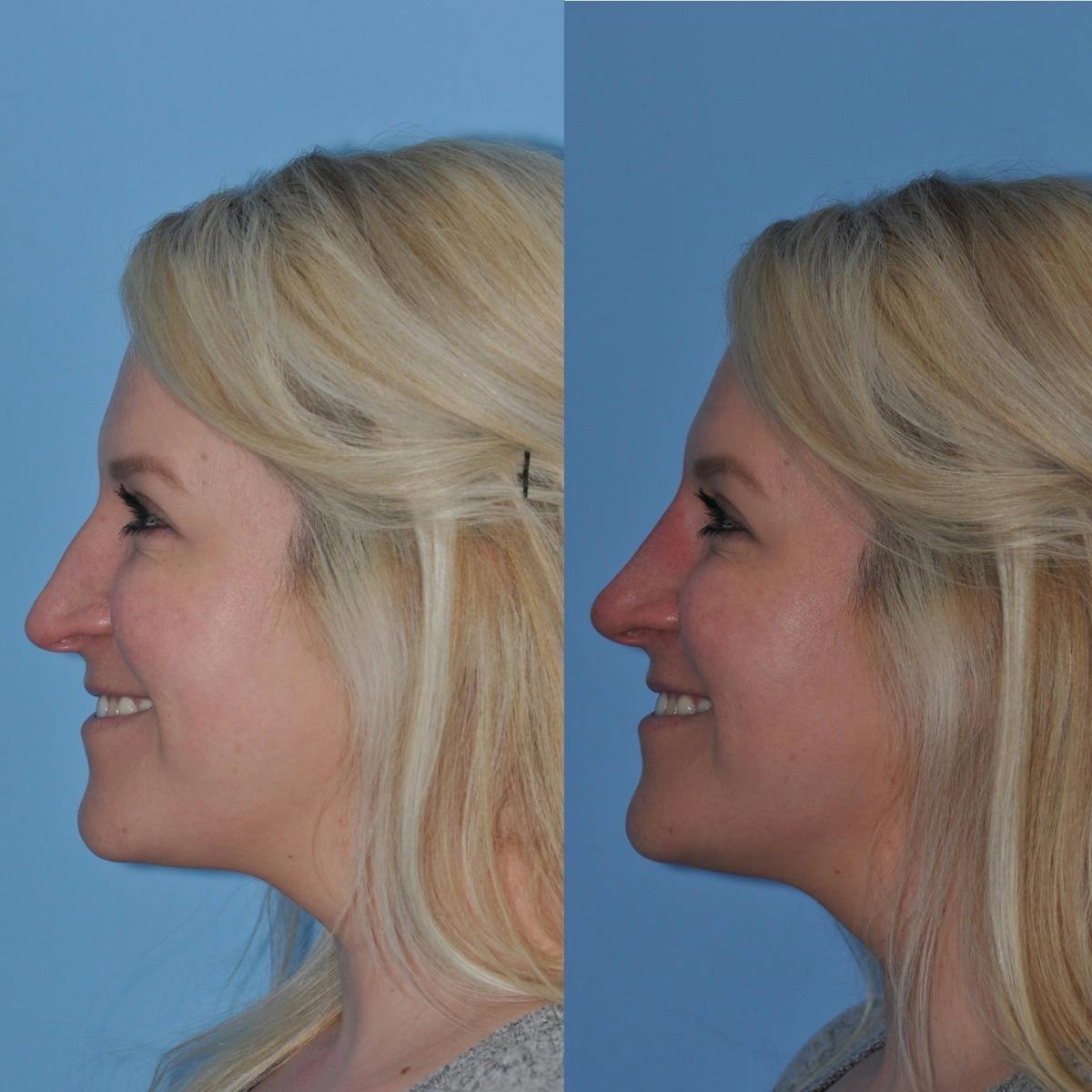 Non-Surgical Rhinoplasty Before & After Gallery - Patient 285241 - Image 3