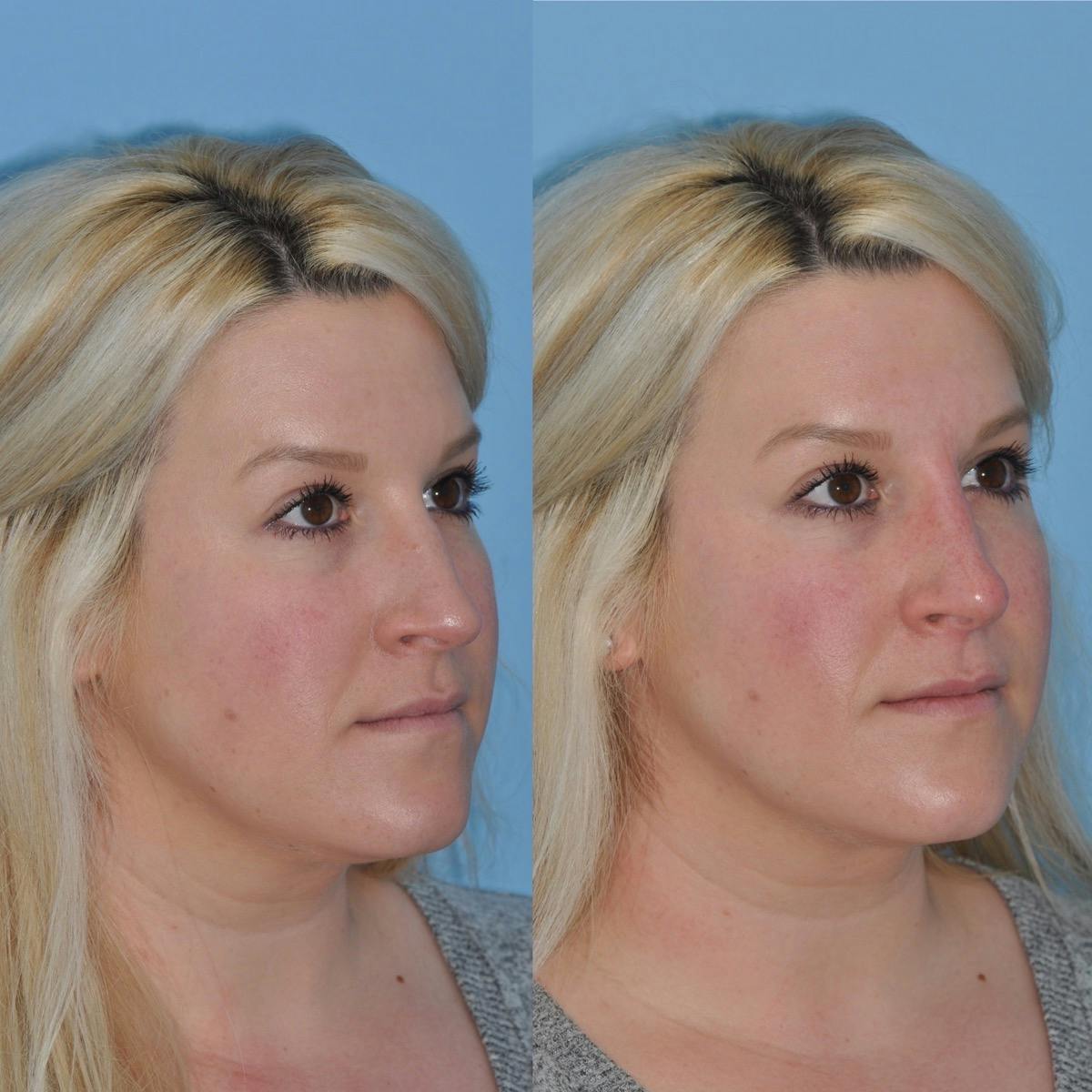 Non-Surgical Rhinoplasty Before & After Gallery - Patient 285241 - Image 4
