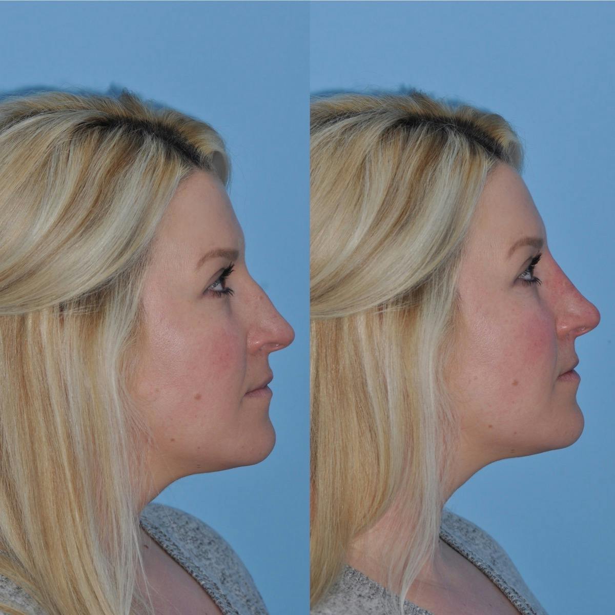 Non-Surgical Rhinoplasty Before & After Gallery - Patient 285241 - Image 5