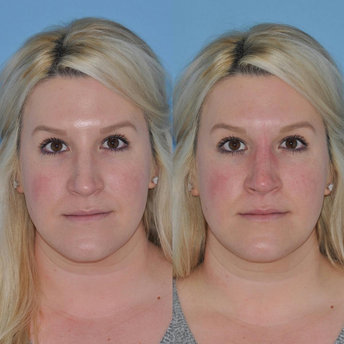 Non-Surgical Rhinoplasty Before & After Gallery - Patient 285241 - Image 6