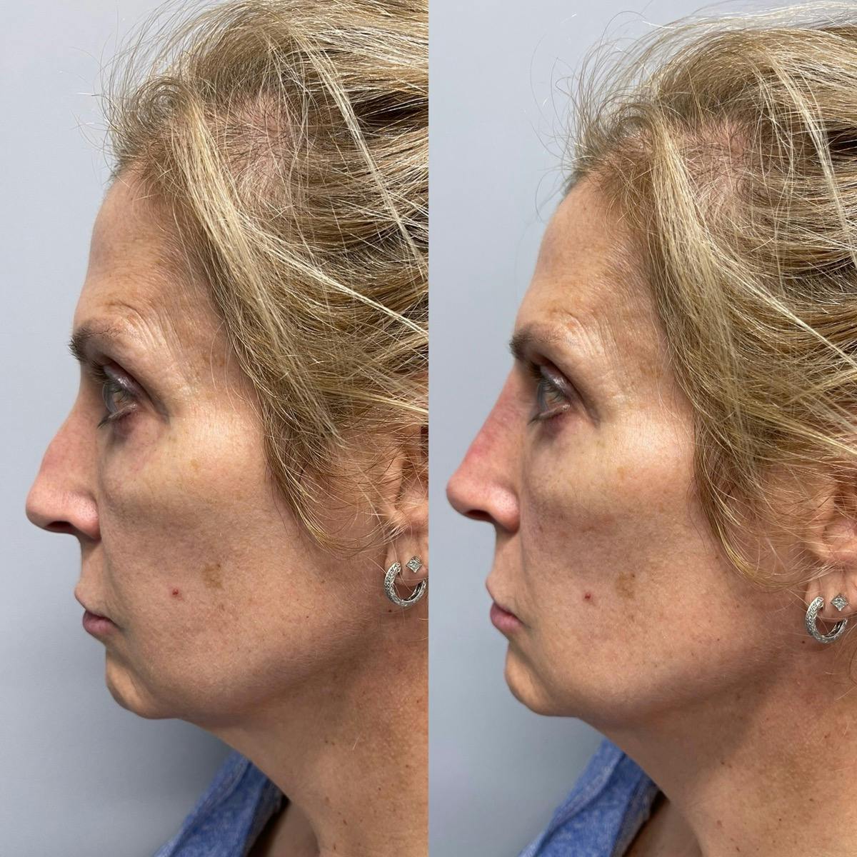 Non-Surgical Rhinoplasty Before & After Gallery - Patient 232484 - Image 2