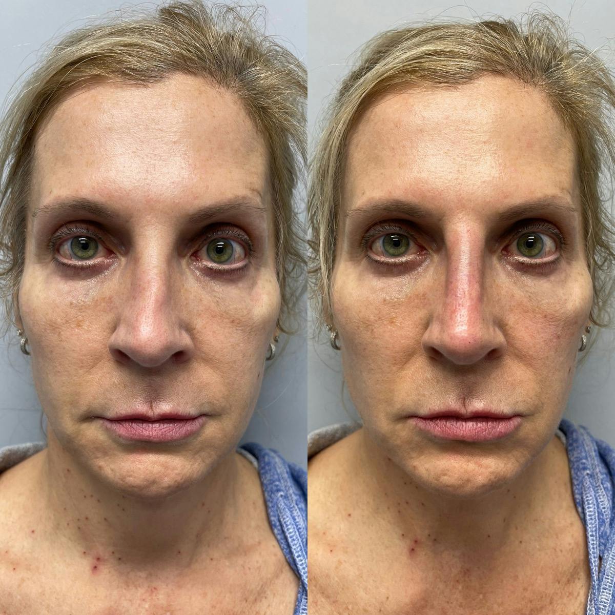 Non-Surgical Rhinoplasty Before & After Gallery - Patient 232484 - Image 3