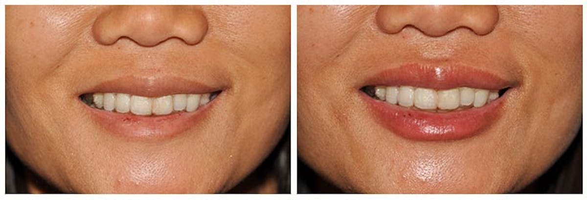 Lip Augmentation Before & After Gallery - Patient 314553 - Image 2