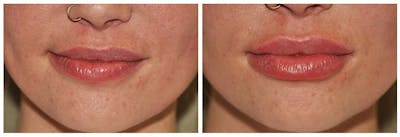 Lip Augmentation Before & After Gallery - Patient 707478 - Image 1