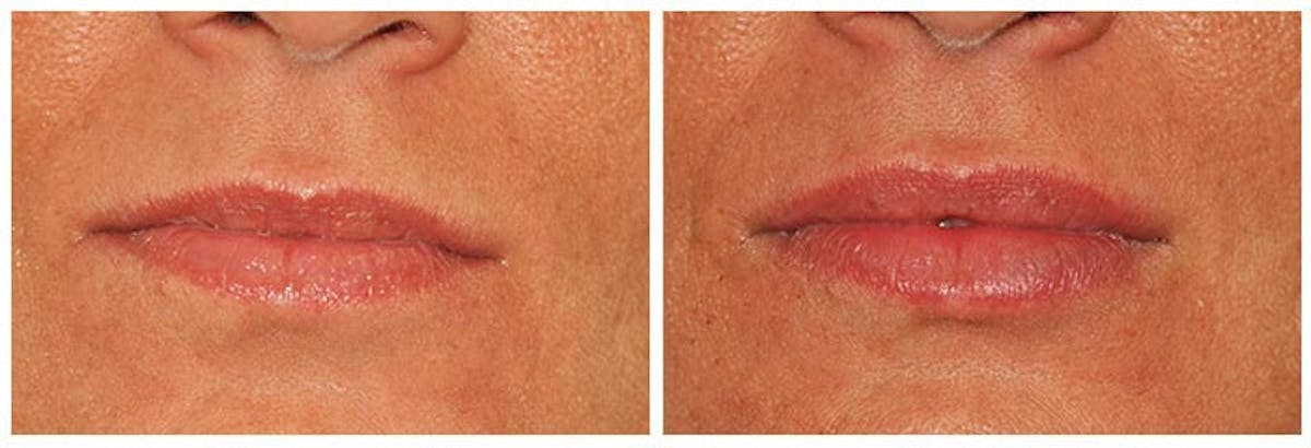 Lip Augmentation Before & After Gallery - Patient 208186 - Image 1