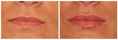 Lip Augmentation Before & After Gallery - Patient 208186 - Image 1