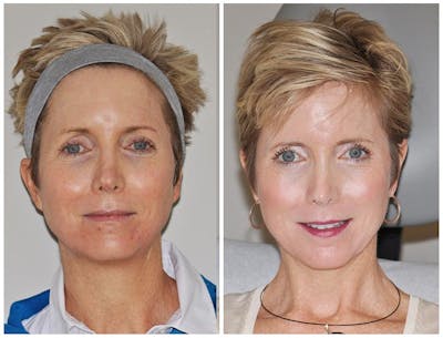 Laser Resurfacing Before & After Gallery - Patient 245034 - Image 1