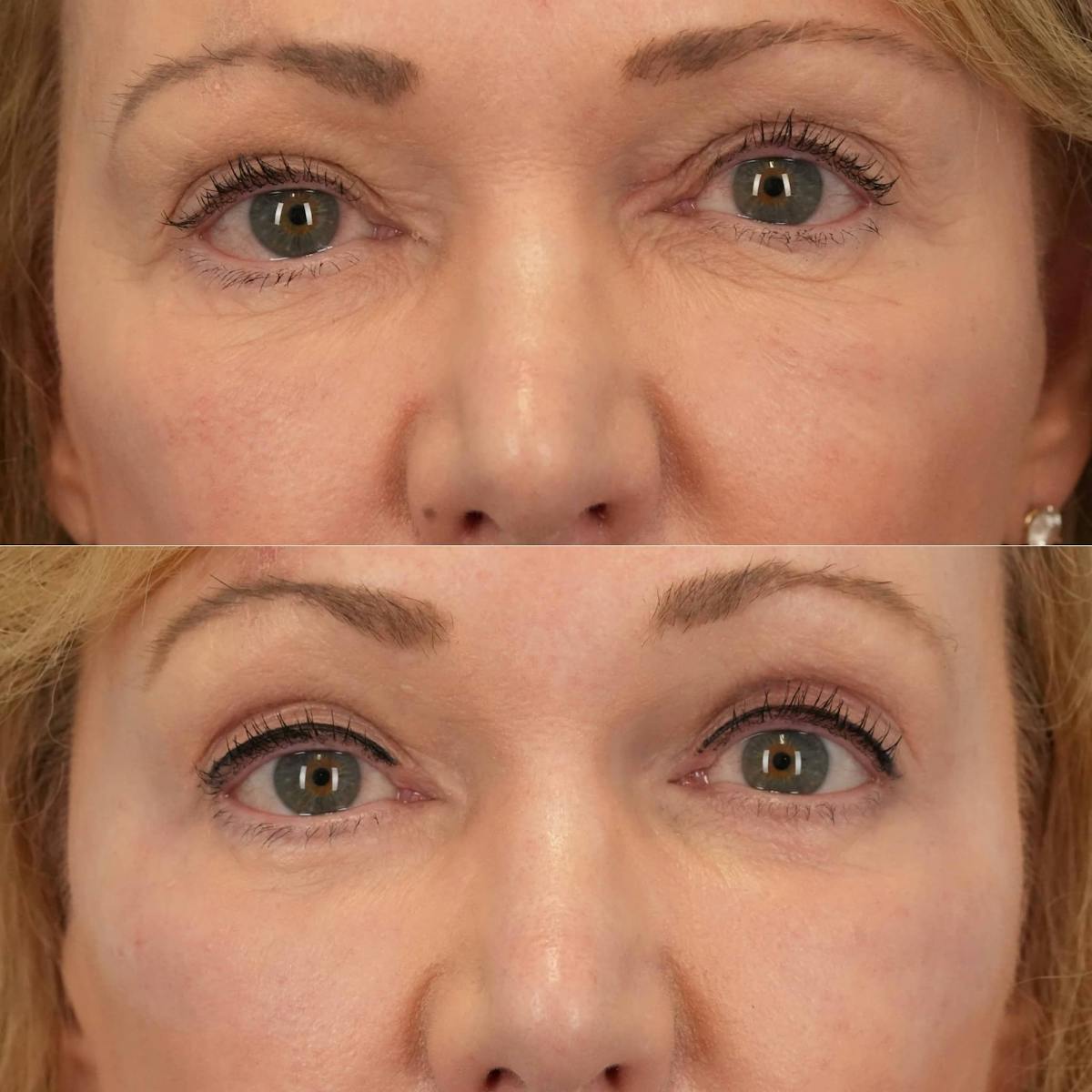 Laser Resurfacing Before & After Gallery - Patient 249143 - Image 1