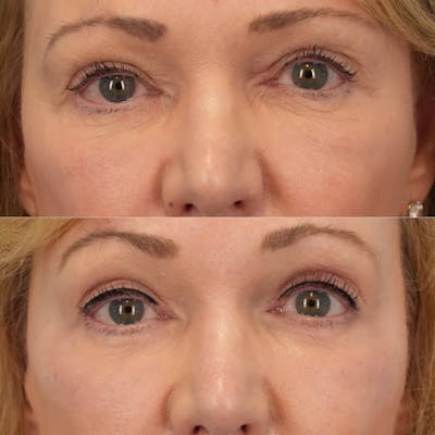 Laser Resurfacing Before & After Gallery - Patient 249143 - Image 1