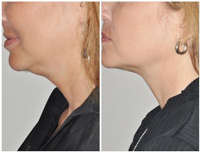 Kybella Before & After Gallery - Patient 244721 - Image 1