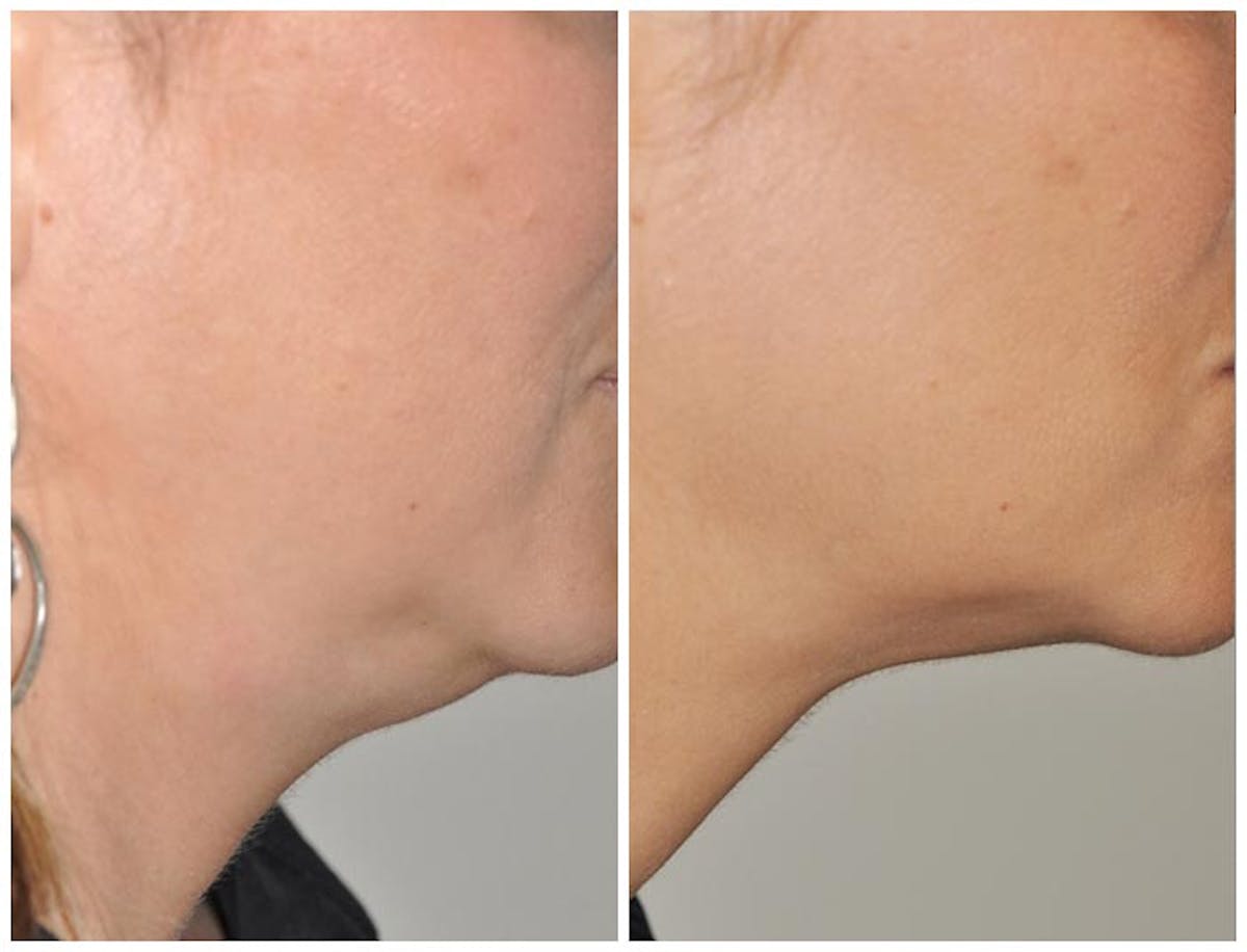 Kybella Before & After Gallery - Patient 244721 - Image 2
