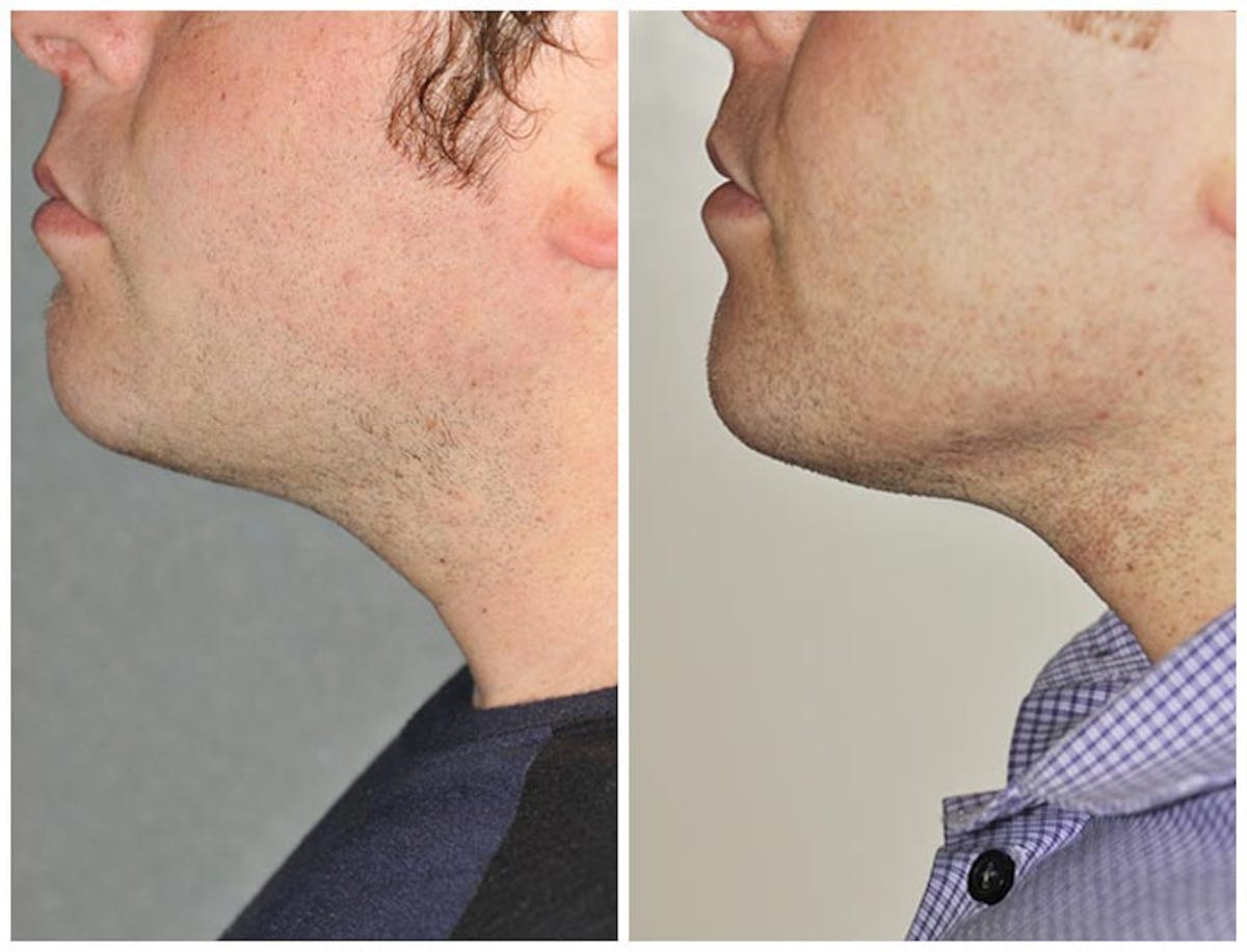 Kybella Before & After Gallery - Patient 398800 - Image 1
