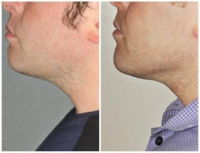 Kybella Before & After Gallery - Patient 398800 - Image 1