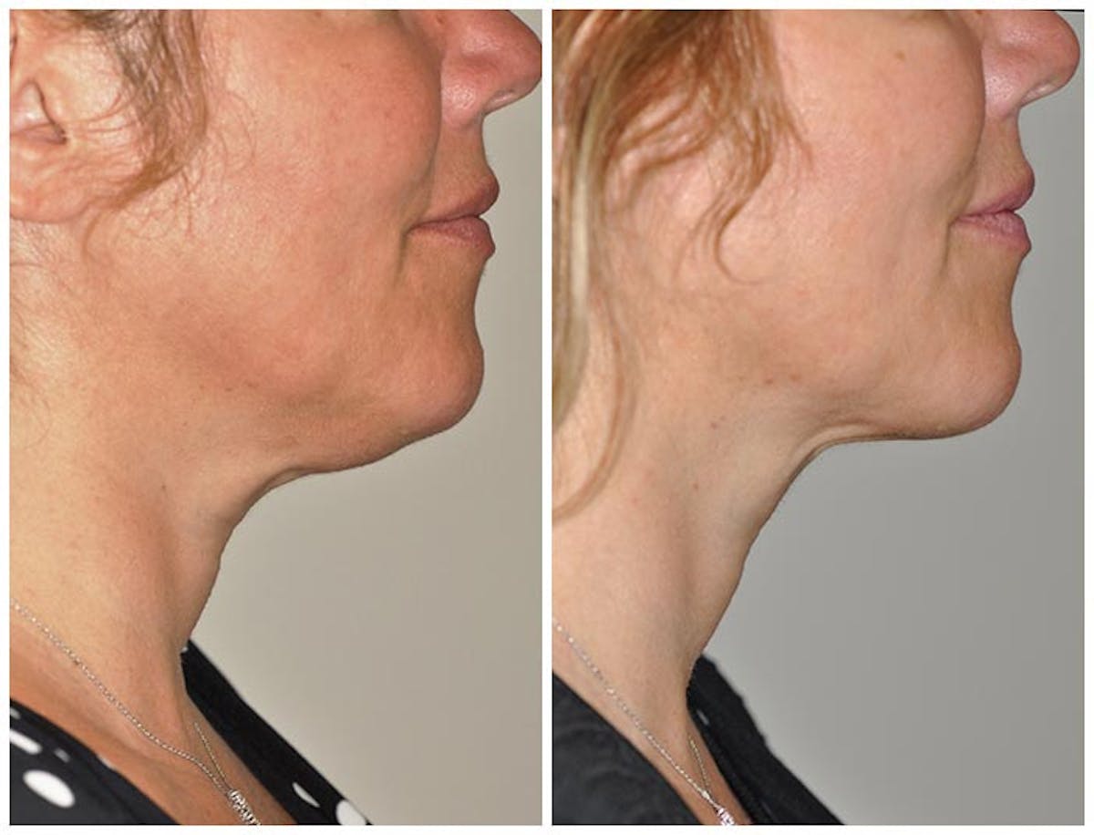 Kybella Before & After Gallery - Patient 275828 - Image 2
