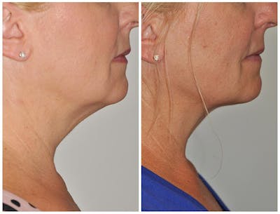 ThermiRF Before & After Gallery - Patient 189394 - Image 1