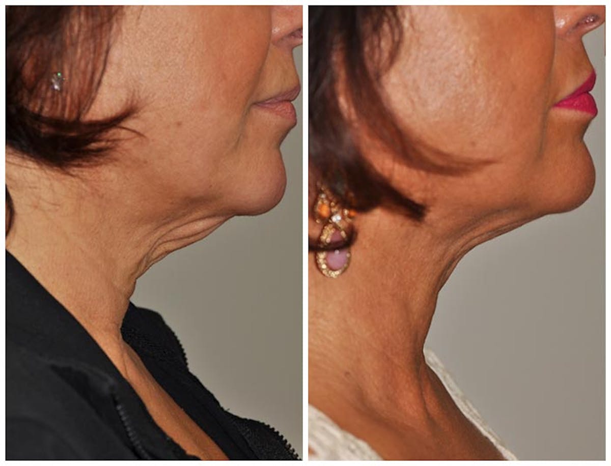 ThermiRF Before & After Gallery - Patient 410213 - Image 1