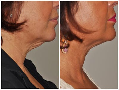 ThermiRF Before & After Gallery - Patient 410213 - Image 1
