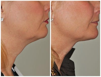 ThermiRF Before & After Gallery - Patient 171006 - Image 1