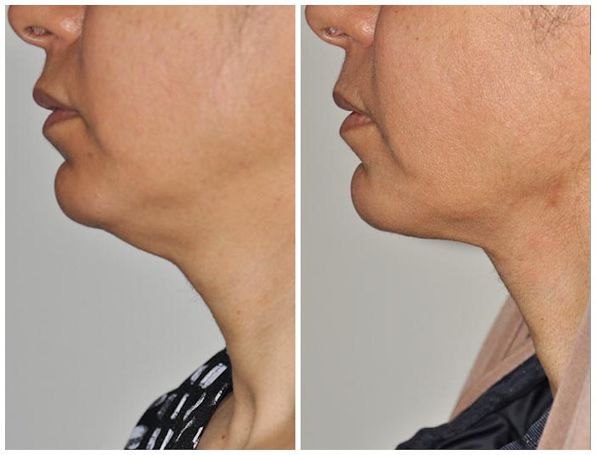 ThermiRF Before & After Gallery - Patient 233602 - Image 1