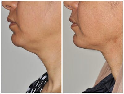 ThermiRF Before & After Gallery - Patient 233602 - Image 1