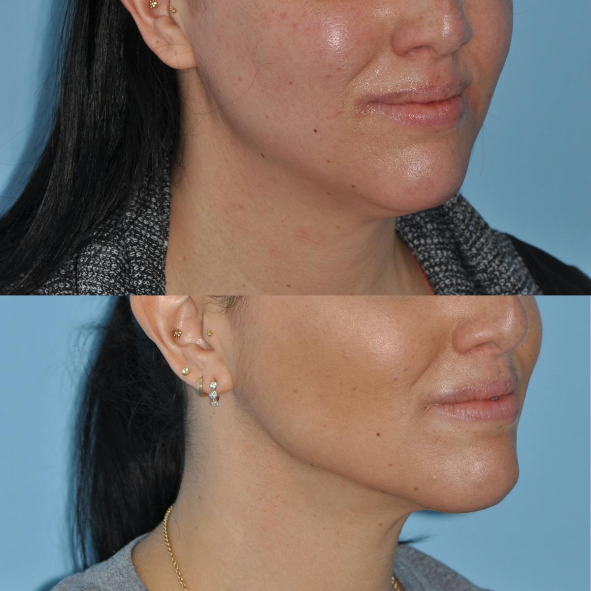 ThermiRF Before & After Gallery - Patient 381961 - Image 2