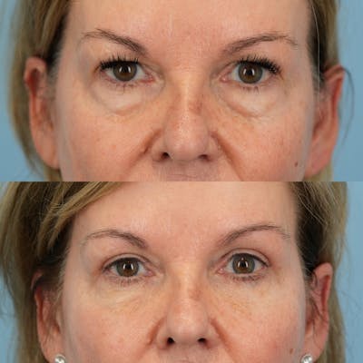 Blepharoplasty Before & After Gallery - Patient 258887 - Image 1