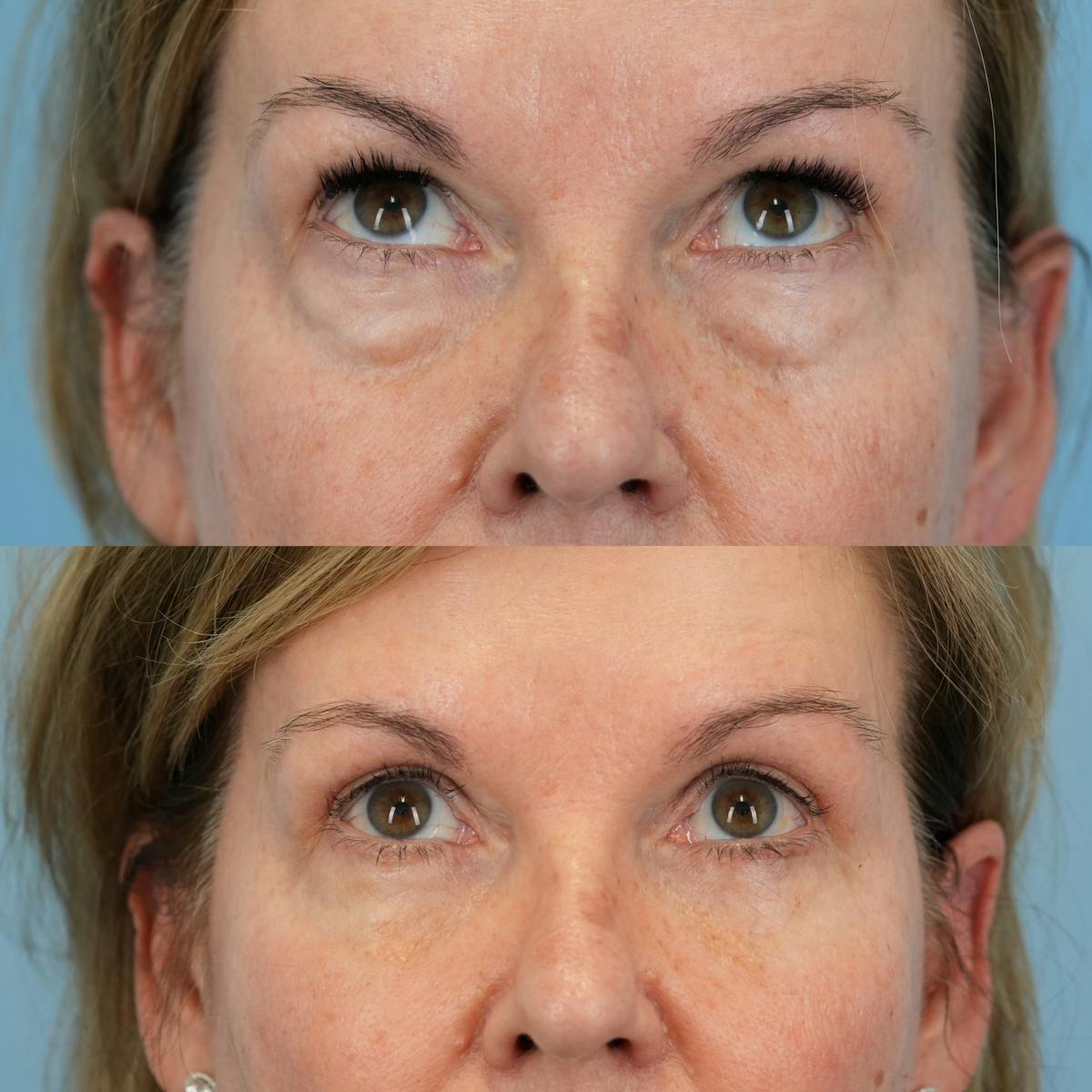 Blepharoplasty Before & After Gallery - Patient 258887 - Image 2