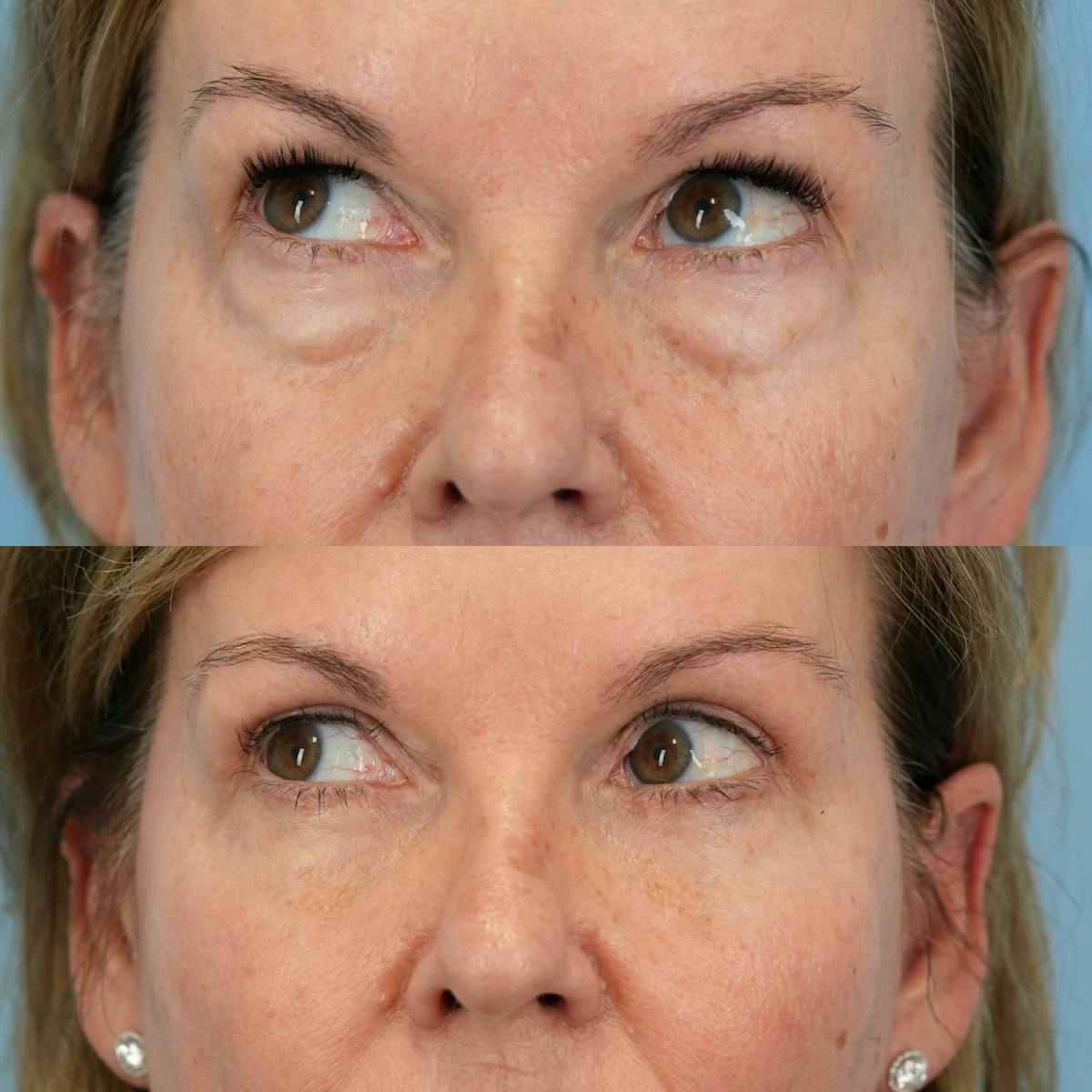 Blepharoplasty Before & After Gallery - Patient 258887 - Image 4
