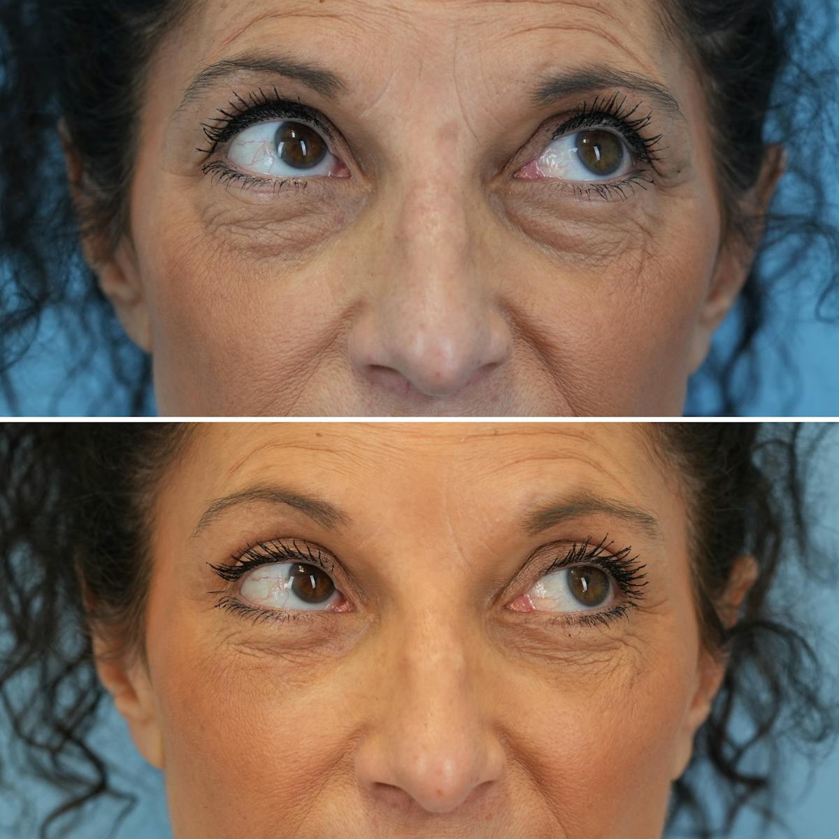 Blepharoplasty Before & After Gallery - Patient 395219 - Image 3