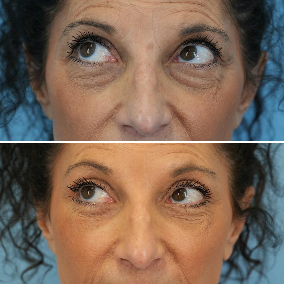 Blepharoplasty Before & After Gallery - Patient 395219 - Image 4