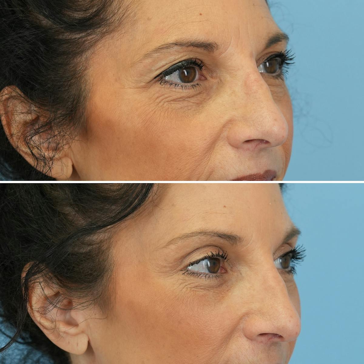 Blepharoplasty Before & After Gallery - Patient 395219 - Image 5