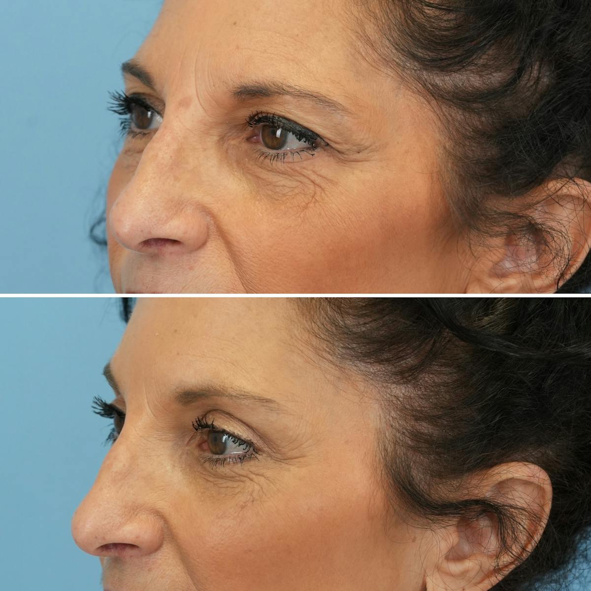 Blepharoplasty Before & After Gallery - Patient 395219 - Image 6
