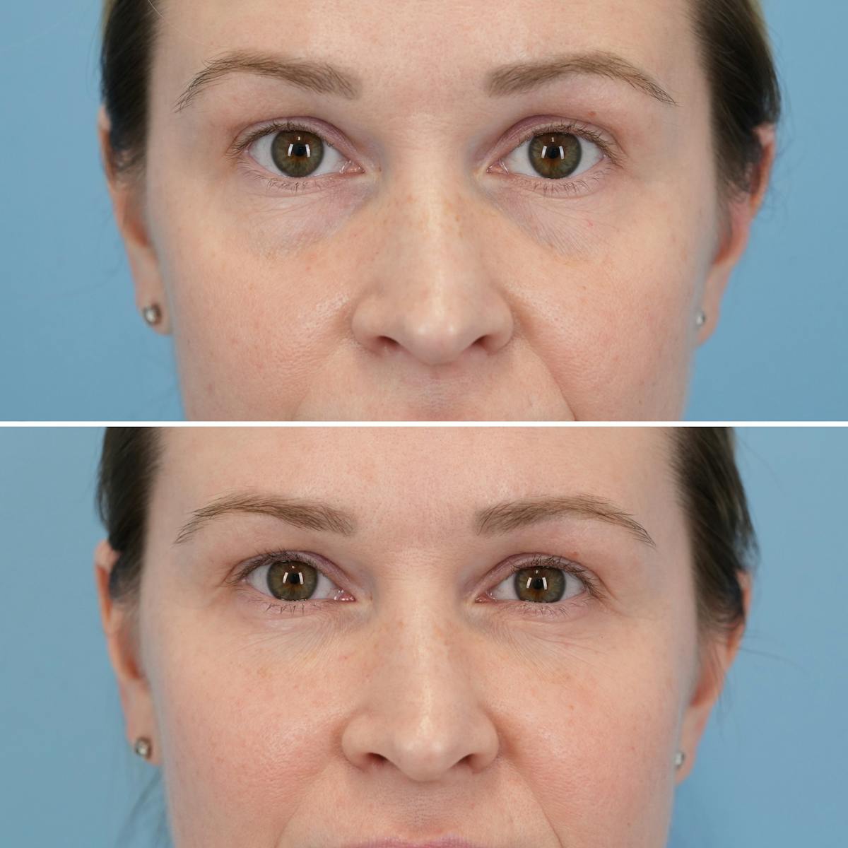 Blepharoplasty Before & After Gallery - Patient 404746 - Image 1