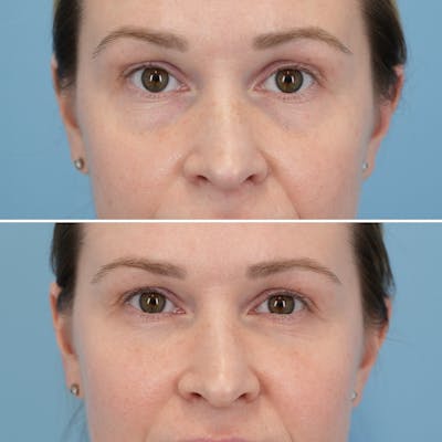Blepharoplasty Before & After Gallery - Patient 404746 - Image 1