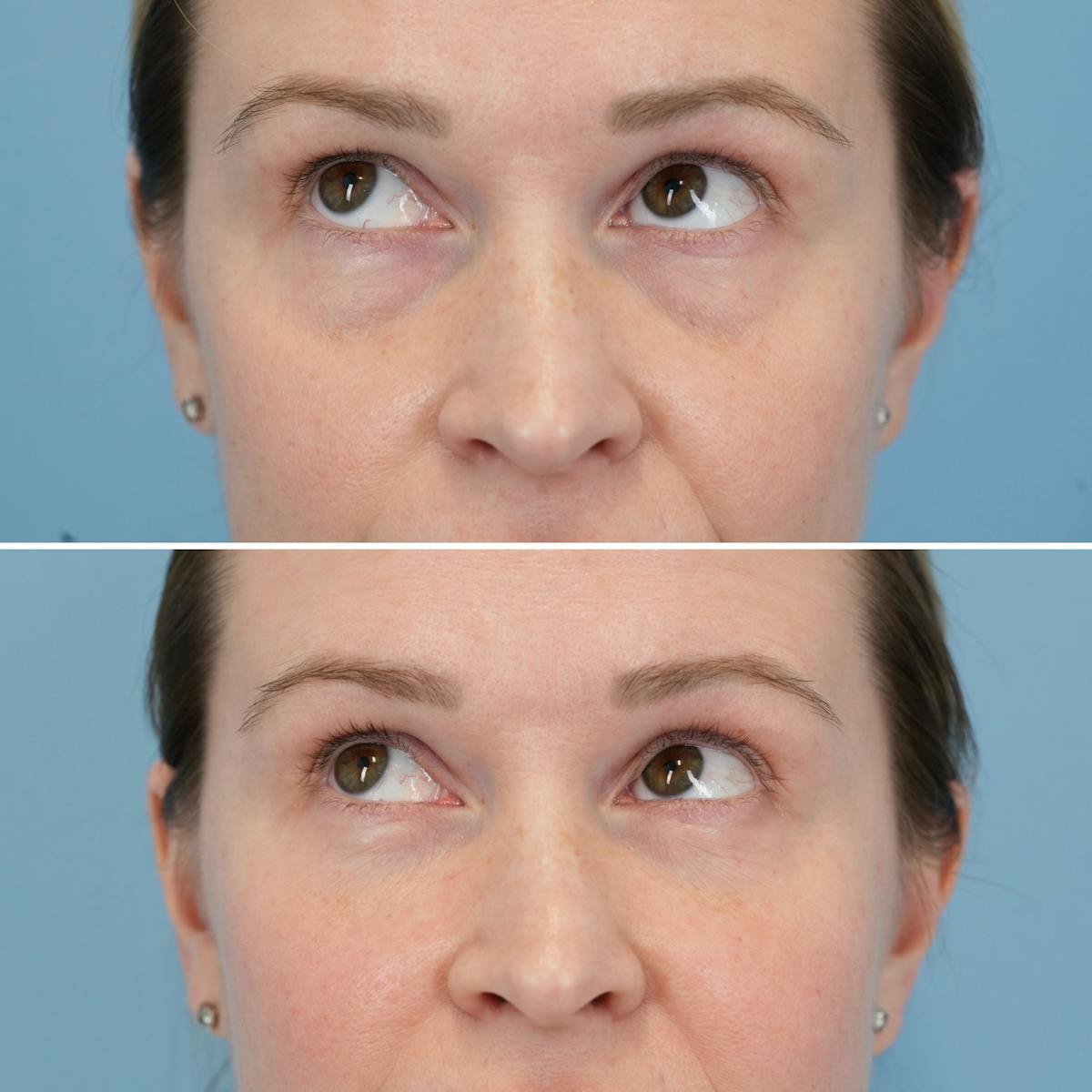 Blepharoplasty Before & After Gallery - Patient 404746 - Image 4