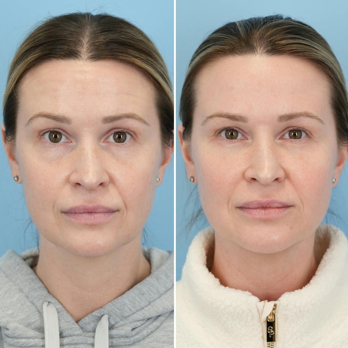 Blepharoplasty Before & After Gallery - Patient 404746 - Image 5