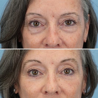 Blepharoplasty Before & After Gallery - Patient 364700 - Image 1