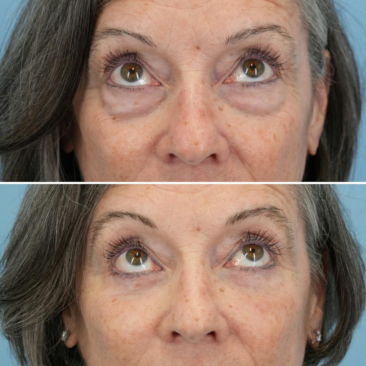 Blepharoplasty Before & After Gallery - Patient 364700 - Image 2