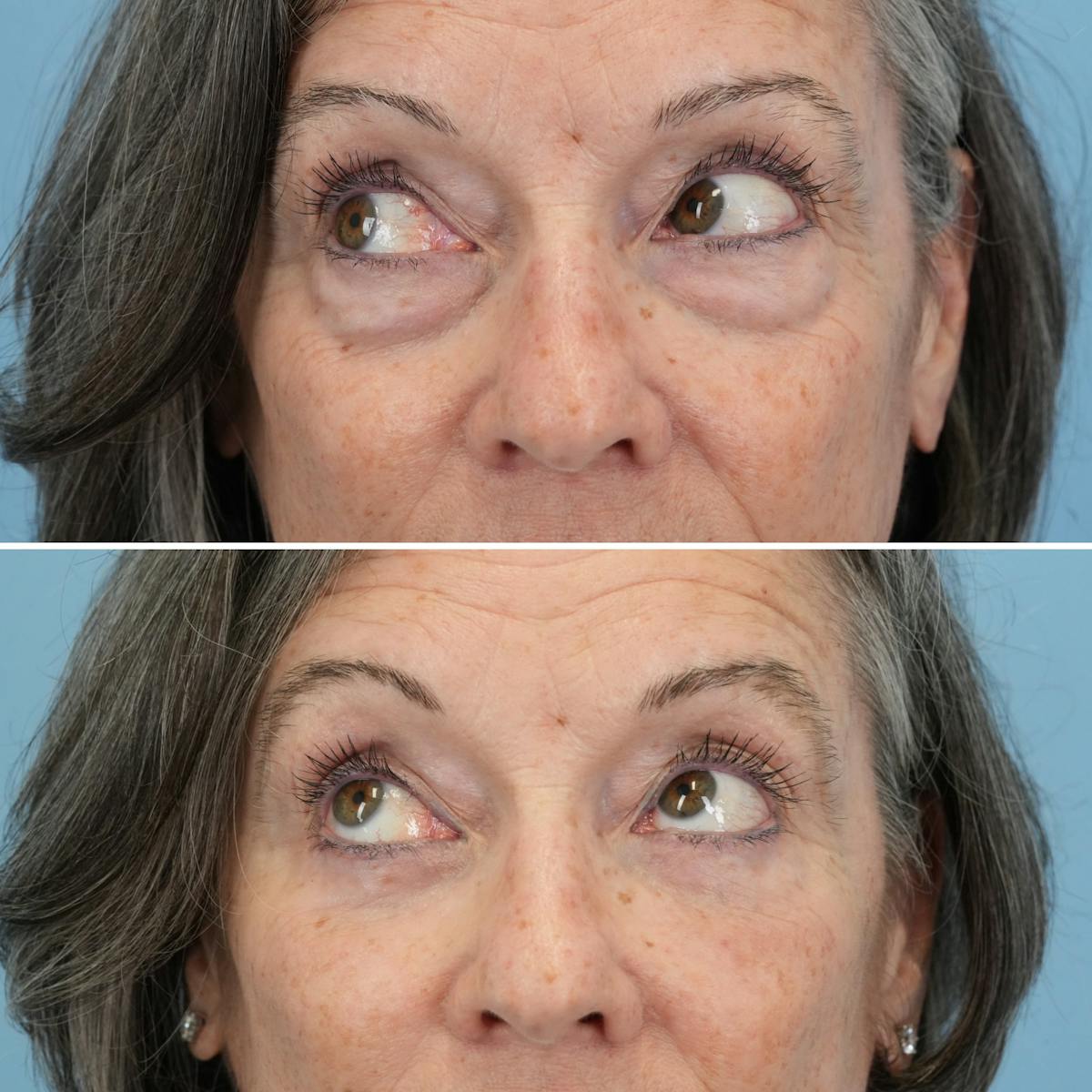 Blepharoplasty Before & After Gallery - Patient 364700 - Image 4