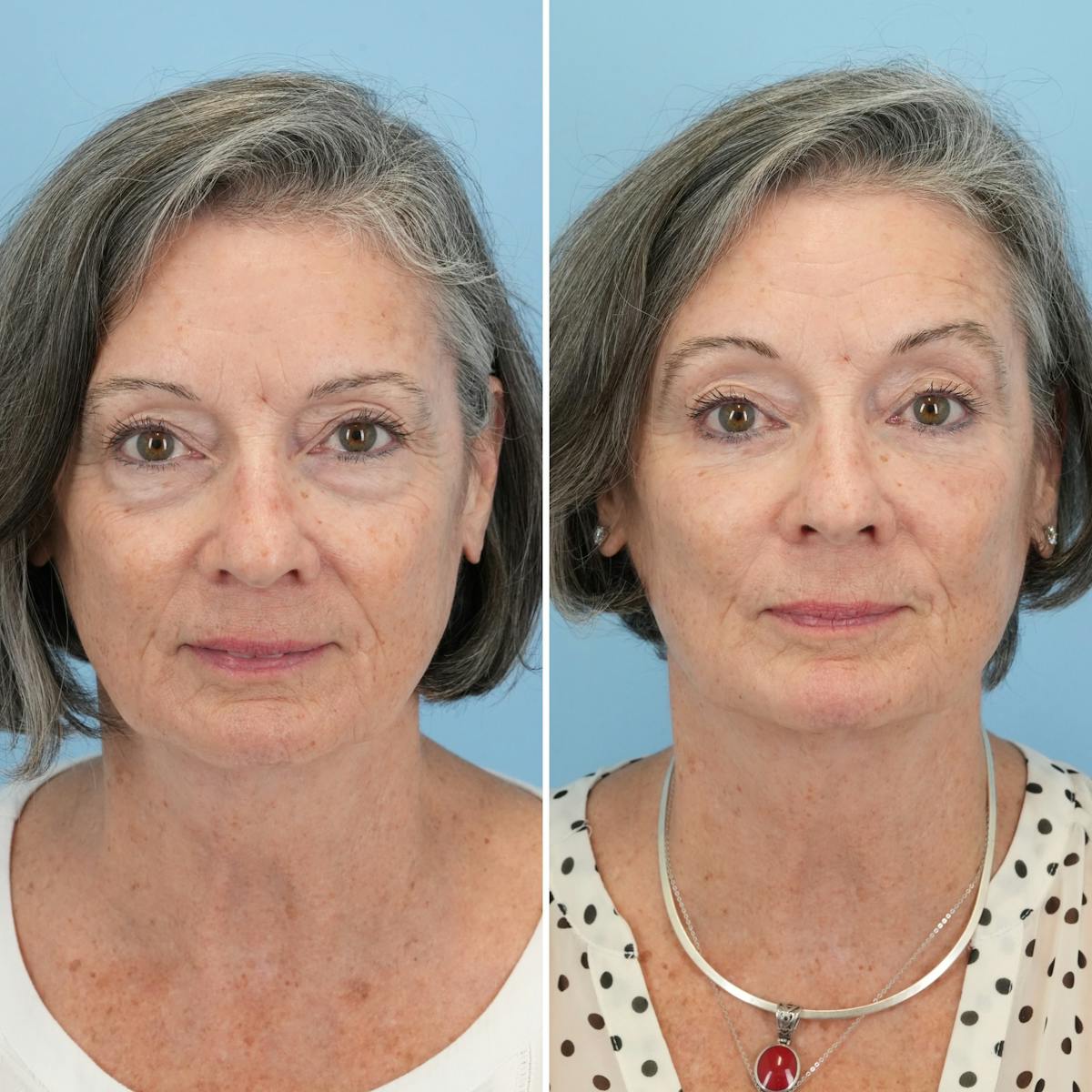 Blepharoplasty Before & After Gallery - Patient 364700 - Image 5