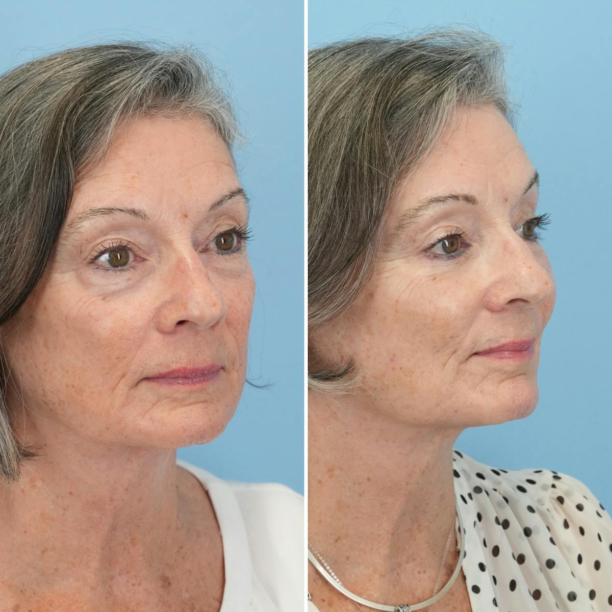 Blepharoplasty Before & After Gallery - Patient 364700 - Image 6