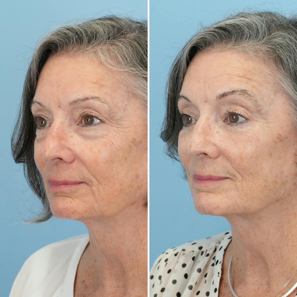 Blepharoplasty Before & After Gallery - Patient 364700 - Image 7
