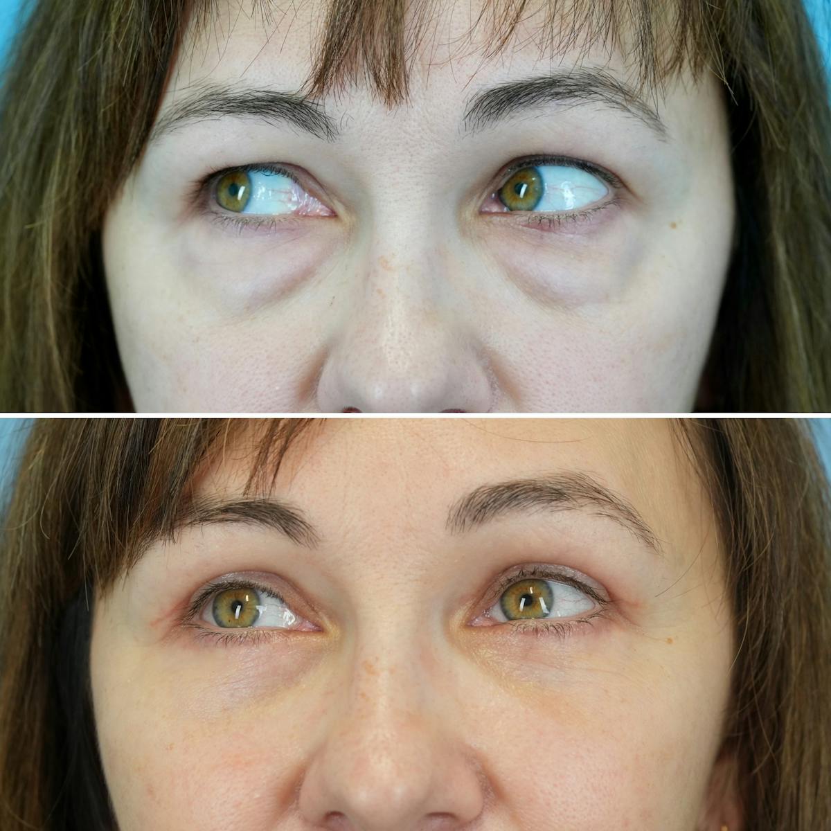 Blepharoplasty Before & After Gallery - Patient 409379 - Image 4