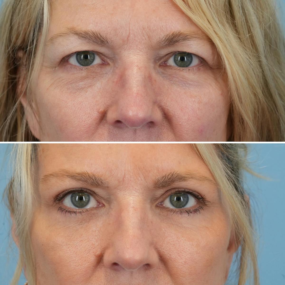 Blepharoplasty Before & After Gallery - Patient 323272 - Image 1