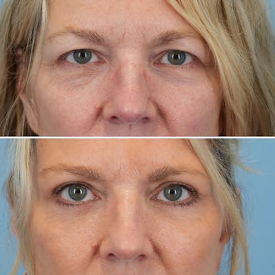 Blepharoplasty Before & After Gallery - Patient 323272 - Image 1