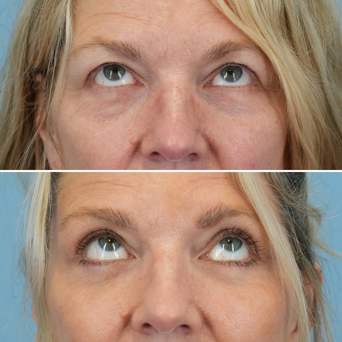 Blepharoplasty Before & After Gallery - Patient 323272 - Image 2